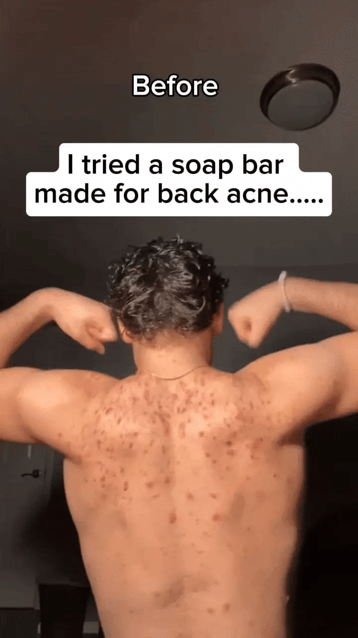 Clear Back Acne In Weeks